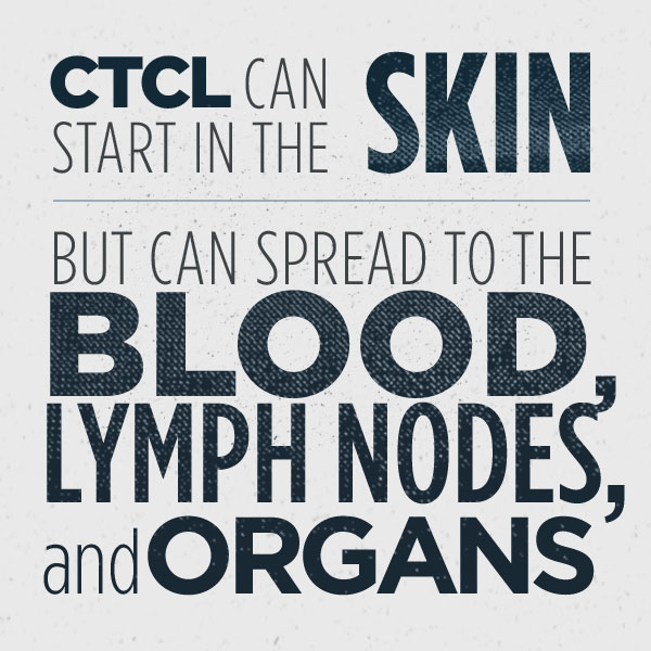 CTCL can start in the skin, but can spread to the blood, lymph nodes, and organs